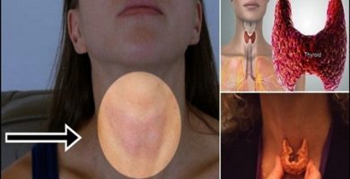 La tiroides