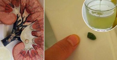 Piedras en los riñones